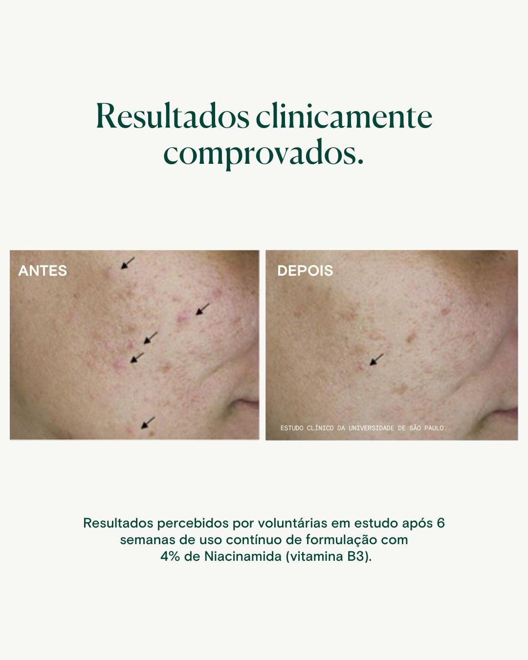 Sérum Antioxidante e Antiacne - Chá Verde e Niacinamida